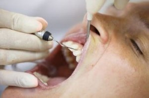 Treating Gum Recession With Grafting